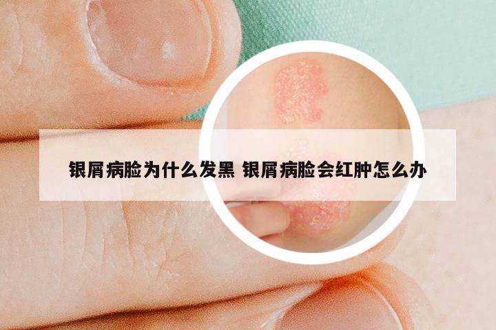 银屑病脸为什么发黑 银屑病脸会红肿怎么办