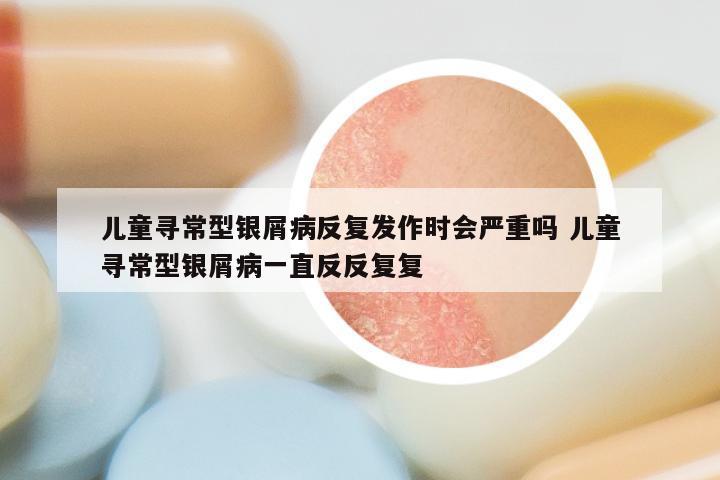 儿童寻常型银屑病反复发作时会严重吗 儿童寻常型银屑病一直反反复复