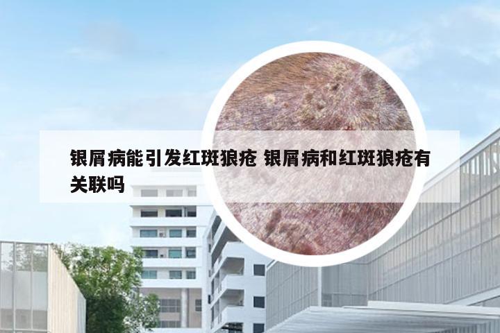 银屑病能引发红斑狼疮 银屑病和红斑狼疮有关联吗