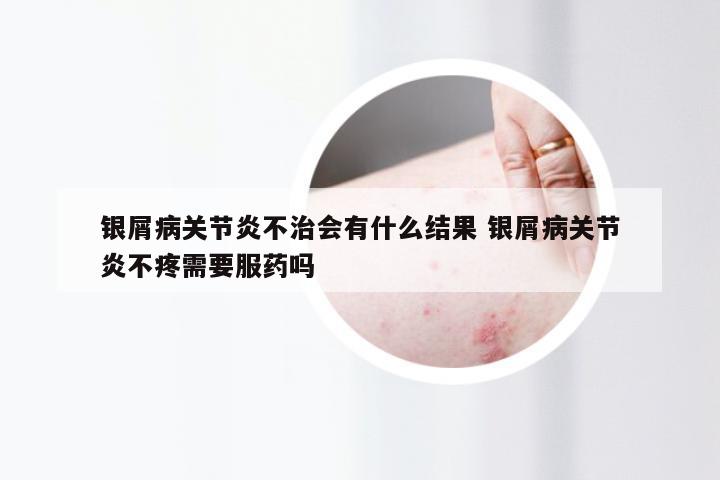 银屑病关节炎不治会有什么结果 银屑病关节炎不疼需要服药吗