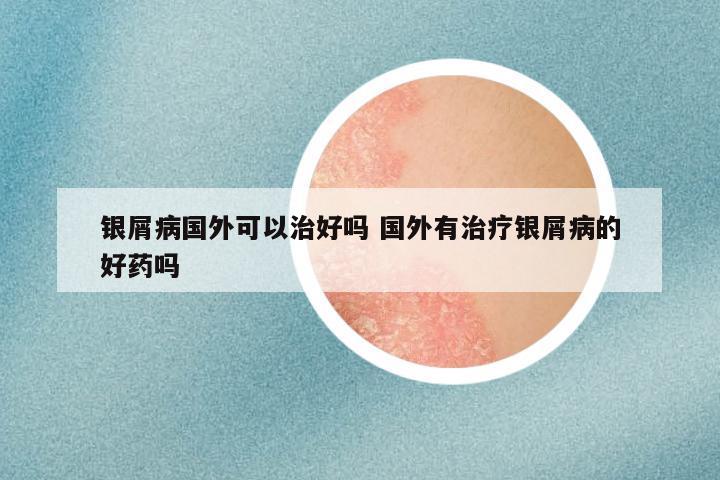 银屑病国外可以治好吗 国外有治疗银屑病的好药吗