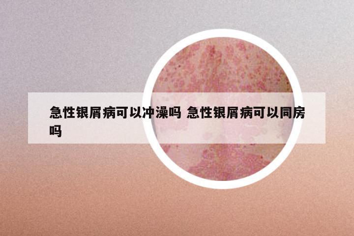急性银屑病可以冲澡吗 急性银屑病可以同房吗