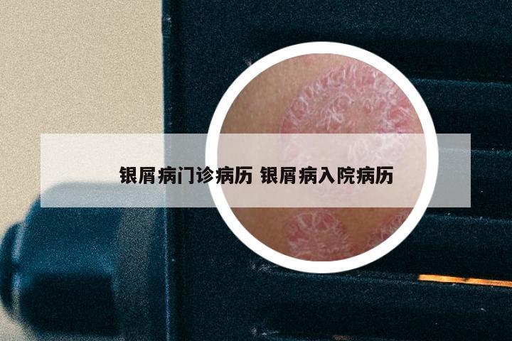 银屑病门诊病历 银屑病入院病历