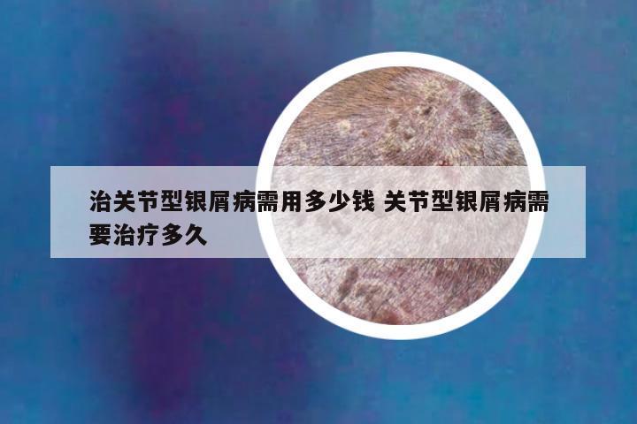 治关节型银屑病需用多少钱 关节型银屑病需要治疗多久