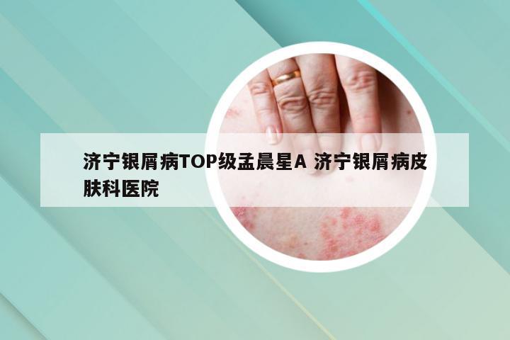 济宁银屑病TOP级孟晨星A 济宁银屑病皮肤科医院
