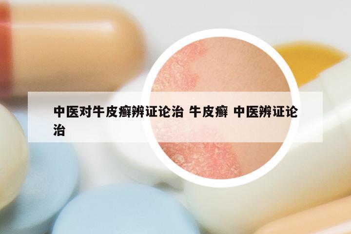 中医对牛皮癣辨证论治 牛皮癣 中医辨证论治