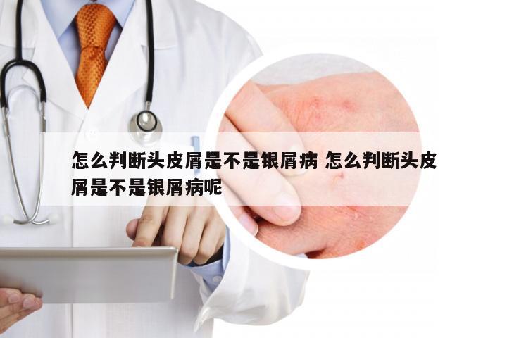 怎么判断头皮屑是不是银屑病 怎么判断头皮屑是不是银屑病呢
