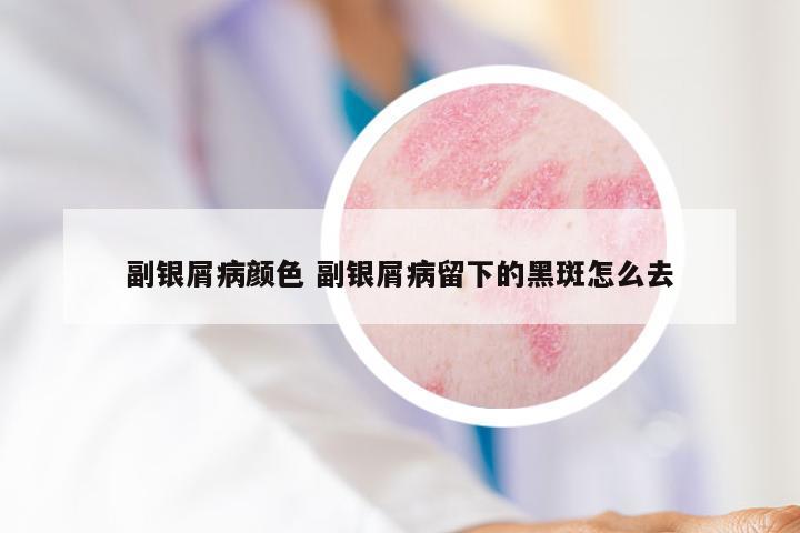 副银屑病颜色 副银屑病留下的黑斑怎么去