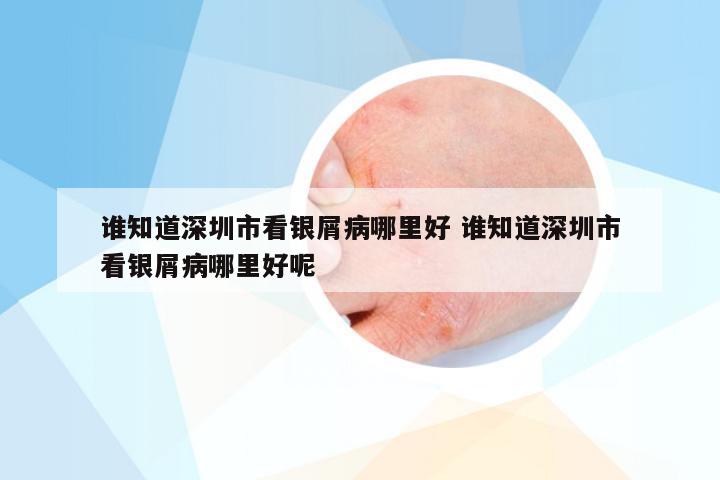 谁知道深圳市看银屑病哪里好 谁知道深圳市看银屑病哪里好呢