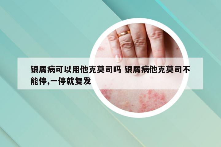 银屑病可以用他克莫司吗 银屑病他克莫司不能停,一停就复发