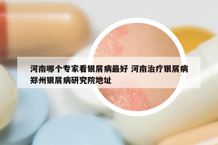 河南哪个专家看银屑病最好 河南治疗银屑病郑州银屑病研究院地址