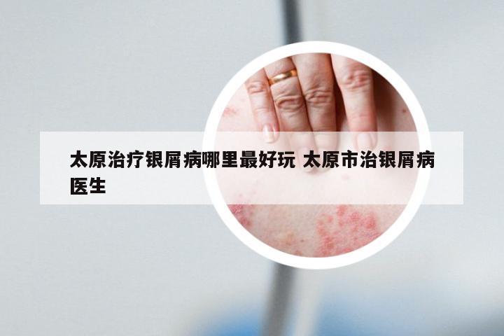 太原治疗银屑病哪里最好玩 太原市治银屑病医生