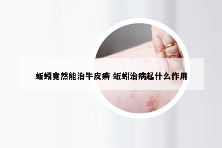 蚯蚓竟然能治牛皮癣 蚯蚓治病起什么作用