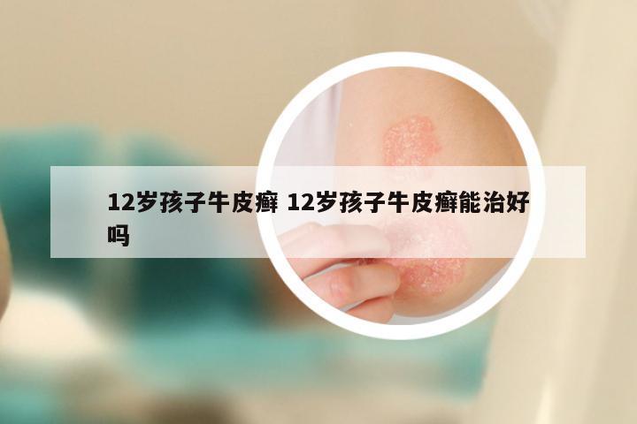12岁孩子牛皮癣 12岁孩子牛皮癣能治好吗