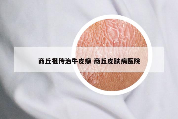 商丘祖传治牛皮癣 商丘皮肤病医院