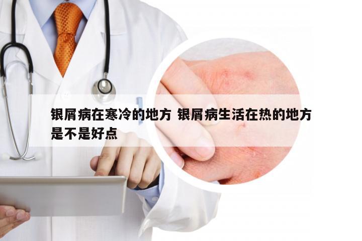 银屑病在寒冷的地方 银屑病生活在热的地方是不是好点