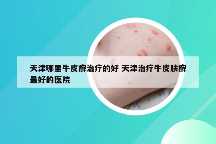 天津哪里牛皮癣治疗的好 天津治疗牛皮肤癣最好的医院