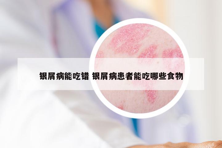 银屑病能吃错 银屑病患者能吃哪些食物