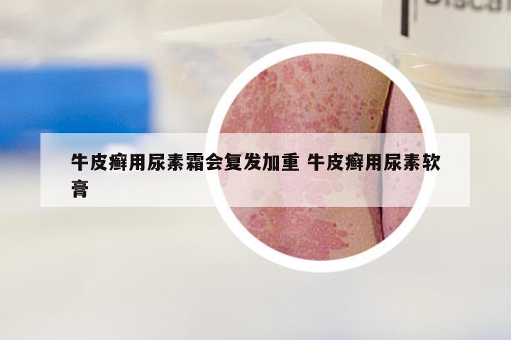 牛皮癣用尿素霜会复发加重 牛皮癣用尿素软膏