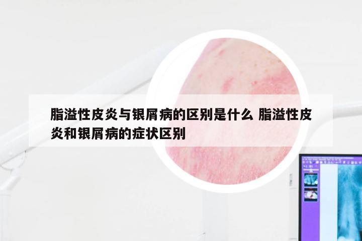 脂溢性皮炎与银屑病的区别是什么 脂溢性皮炎和银屑病的症状区别