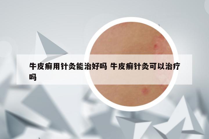 牛皮癣用针灸能治好吗 牛皮癣针灸可以治疗吗
