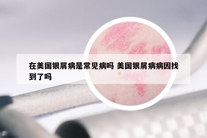 在美国银屑病是常见病吗 美国银屑病病因找到了吗