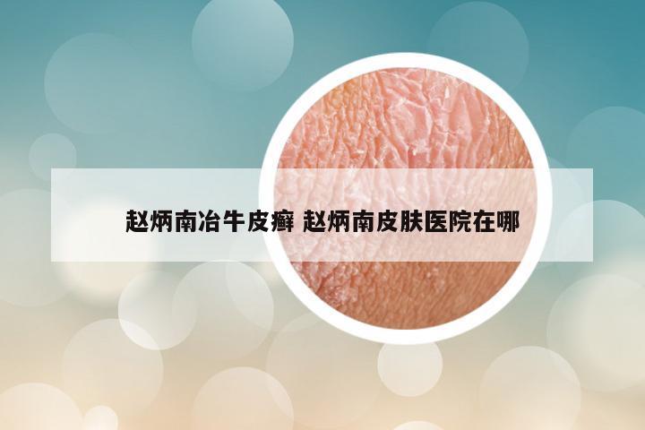 赵炳南冶牛皮癣 赵炳南皮肤医院在哪