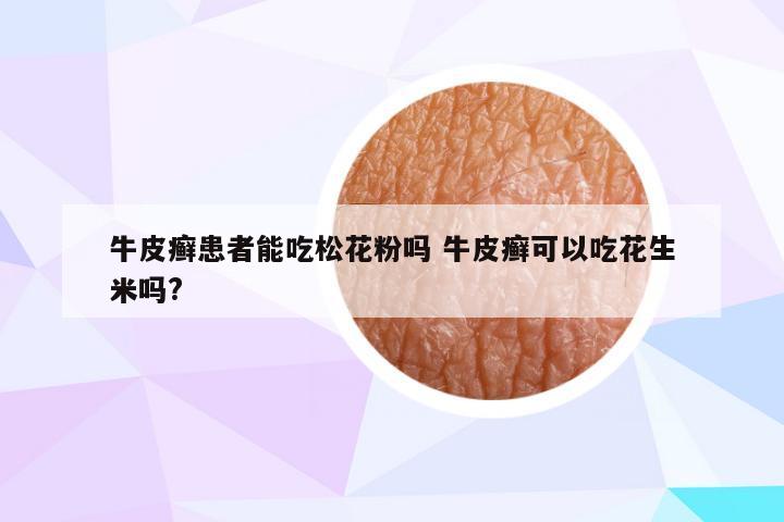 牛皮癣患者能吃松花粉吗 牛皮癣可以吃花生米吗?