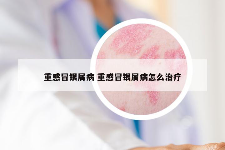 重感冒银屑病 重感冒银屑病怎么治疗