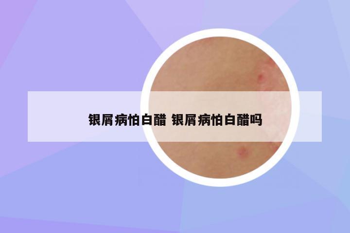 银屑病怕白醋 银屑病怕白醋吗