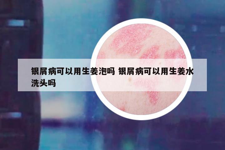 银屑病可以用生姜泡吗 银屑病可以用生姜水洗头吗