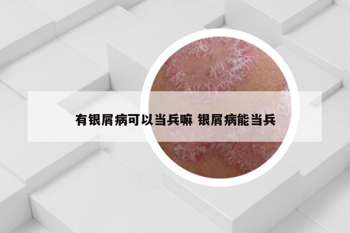 有银屑病可以当兵嘛 银屑病能当兵