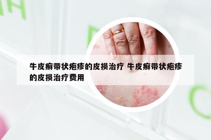 牛皮癣带状疱疹的皮损治疗 牛皮癣带状疱疹的皮损治疗费用