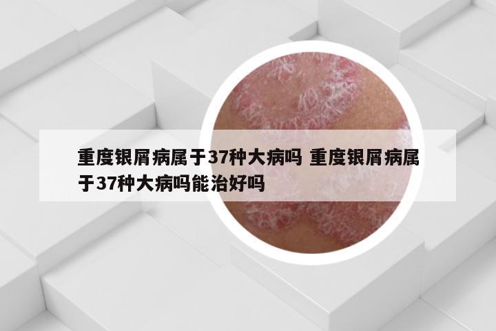 重度银屑病属于37种大病吗 重度银屑病属于37种大病吗能治好吗