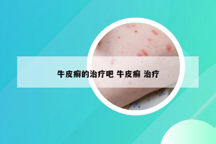 牛皮癣的治疗吧 牛皮癣 治疗