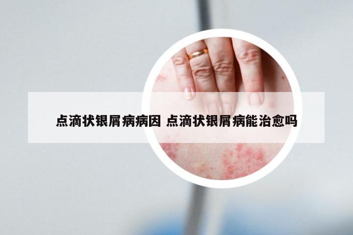 点滴状银屑病病因 点滴状银屑病能治愈吗