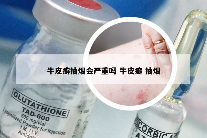 牛皮癣抽烟会严重吗 牛皮癣 抽烟