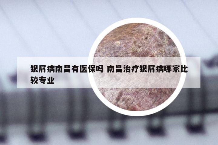 银屑病南昌有医保吗 南昌治疗银屑病哪家比较专业