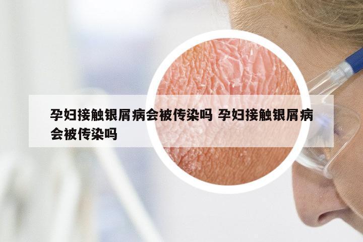 孕妇接触银屑病会被传染吗 孕妇接触银屑病会被传染吗