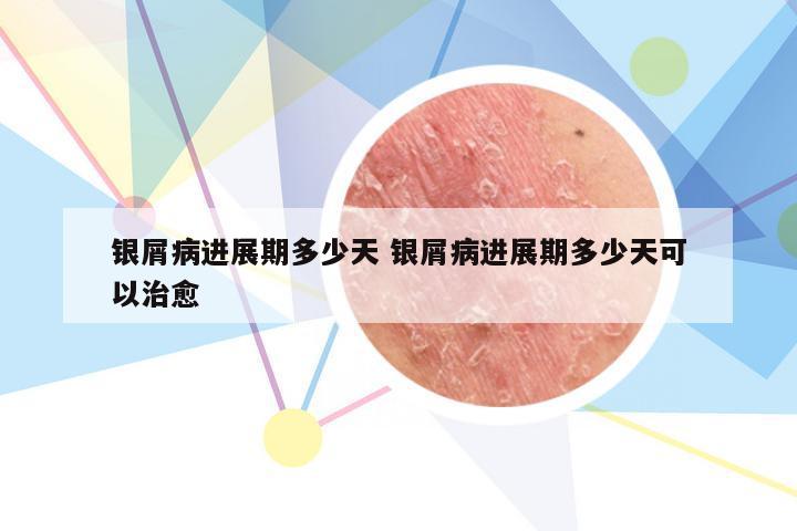 银屑病进展期多少天 银屑病进展期多少天可以治愈