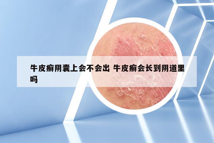 牛皮癣阴囊上会不会出 牛皮癣会长到阴道里吗