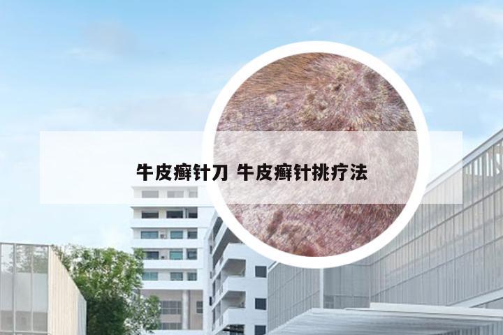 牛皮癣针刀 牛皮癣针挑疗法