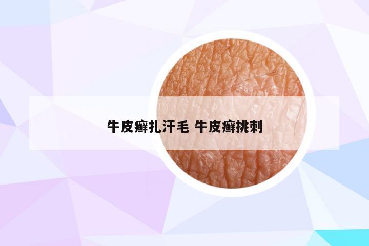 牛皮癣扎汗毛 牛皮癣挑刺