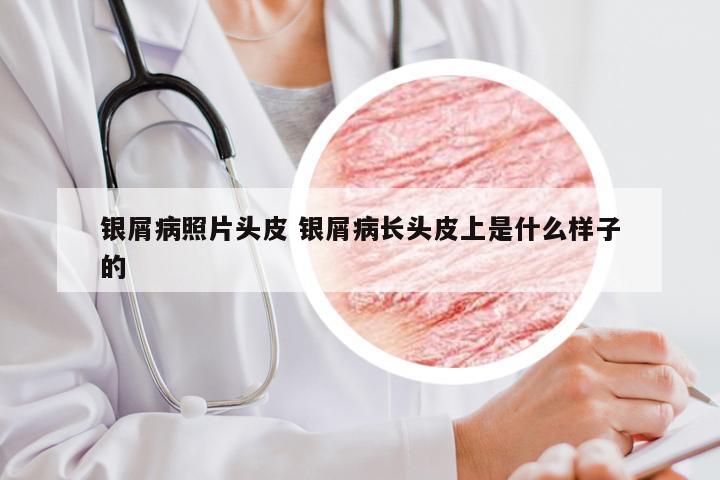 银屑病照片头皮 银屑病长头皮上是什么样子的