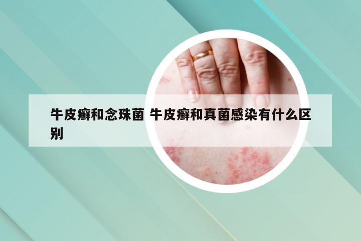 牛皮癣和念珠菌 牛皮癣和真菌感染有什么区别