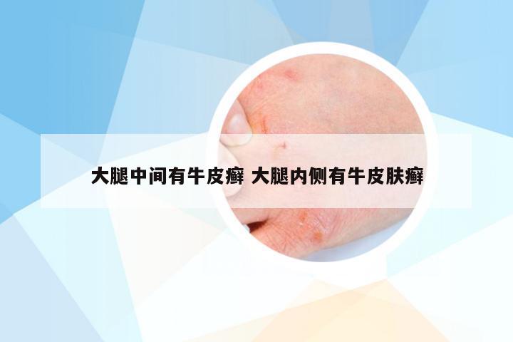 大腿中间有牛皮癣 大腿内侧有牛皮肤癣
