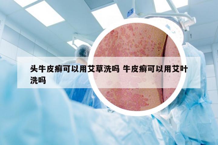 头牛皮癣可以用艾草洗吗 牛皮癣可以用艾叶洗吗