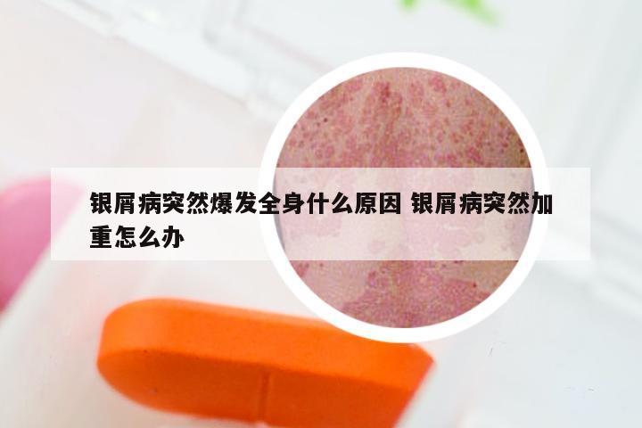 银屑病突然爆发全身什么原因 银屑病突然加重怎么办