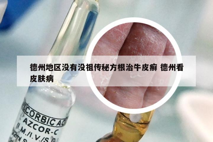 德州地区没有没祖传秘方根治牛皮癣 德州看皮肤病