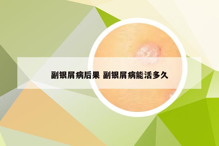 副银屑病后果 副银屑病能活多久